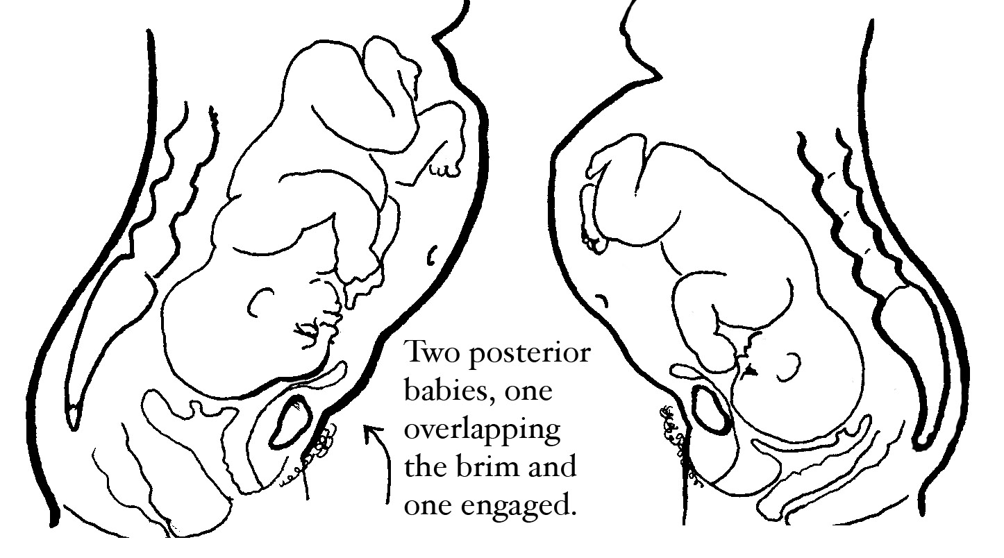 breech presentation with posterior placenta