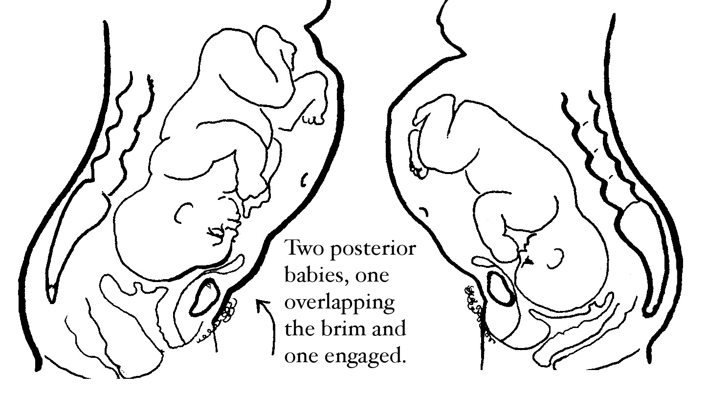 posterior presentation in pregnancy