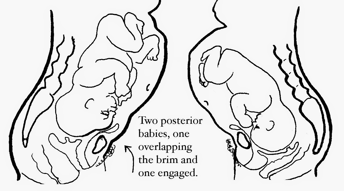 Spinning Babies Pregnant people can tell if the baby is resting on the pubic bone. Midwives can help them determine whether the head is overlapping or not. They may need to have the possibility of an overlapping head pointed out to them. It's not in the textbooks. It's only here, at Spinning Babies!