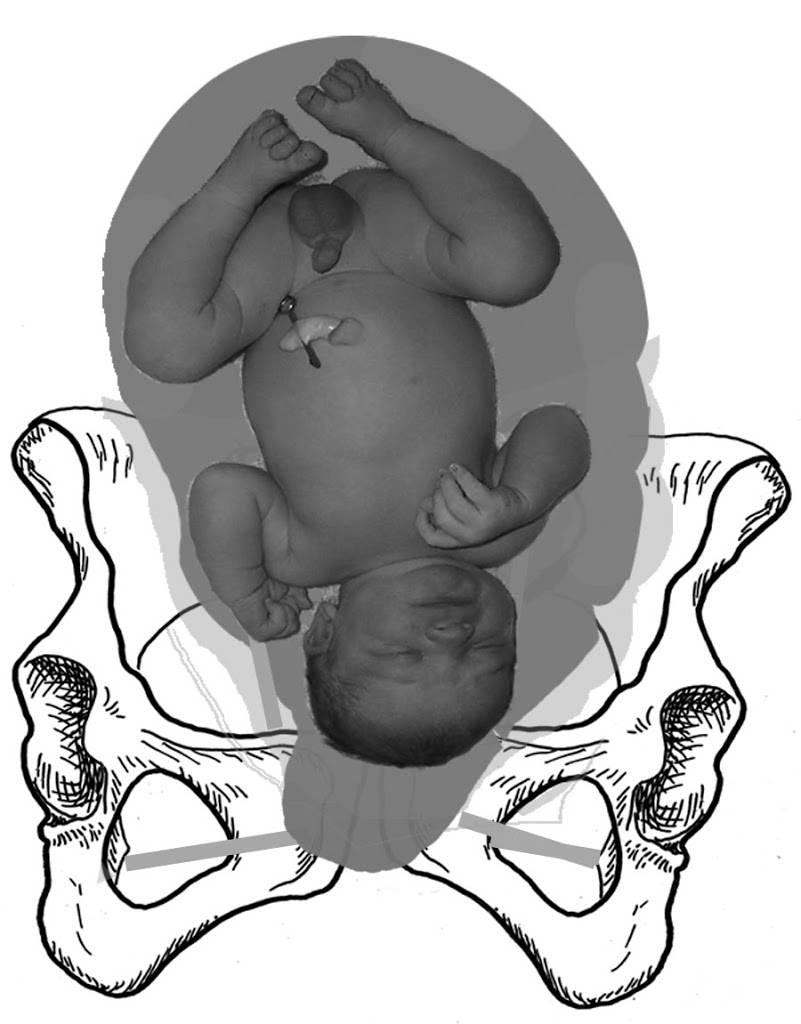 Uterus in a Twist Spinning Babies When seeking an answer about what to do to protect the normalcy of birth, Spinning Babies asks the question, Where is Baby?