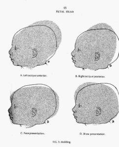 Spinning Babies If the difficulty comes from the curvature of the lumbar region ... put the parturient in a position with her knees flexed so that, with the vulva situated at the top, the pathways are easier.