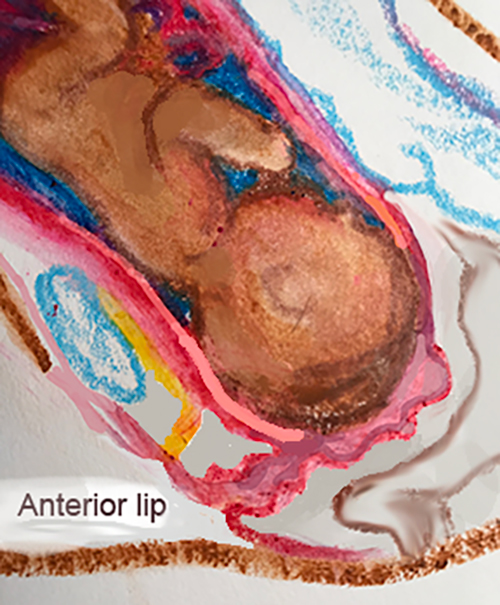 Spinning Babies This week is Part 2 of our discussion on the potential of Dynamic Body Balancing techniques in caring for a labor with a cervical lip. Read Part 1 here.