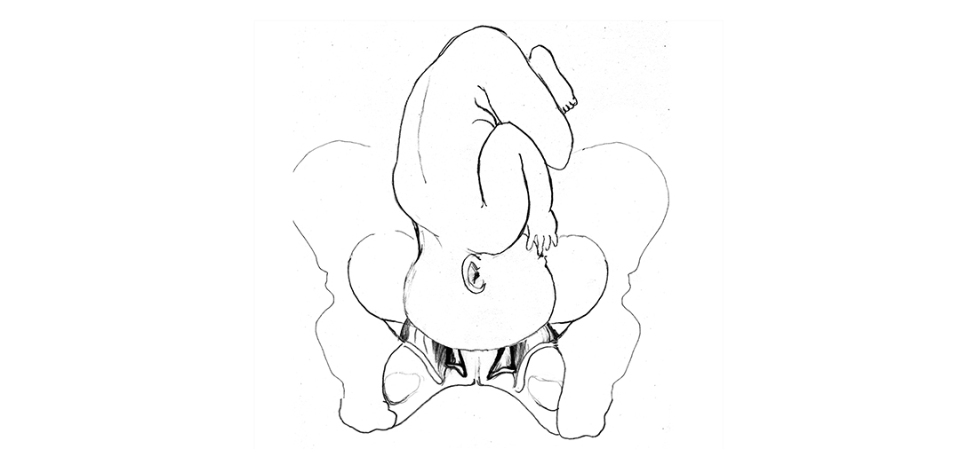 ROT pelvic floor Transverse arrest midpelvis